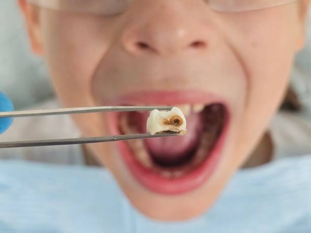 Best Emergency Wisdom Teeth Removal in Lake Mohawk, NJ